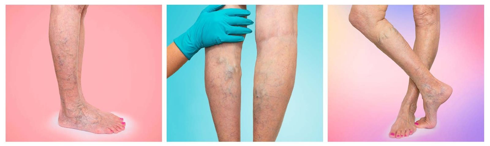 Understanding Spider Veins AND THEIR TREATMENTS Professional Beauty